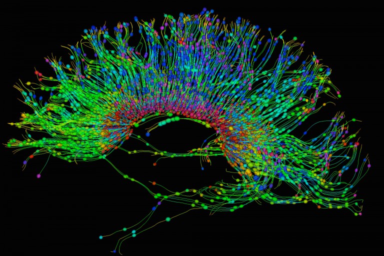A diffusion MRI scan of the brain