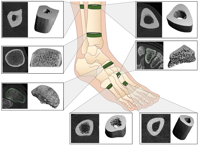 A graphic showing areas in the shin and foot where bone stress injuries frequently occurs