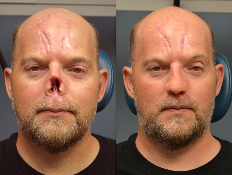 Composite of Jerry Faber without and with his nose prosthesis