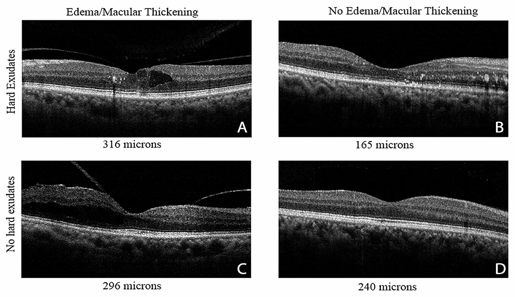 Imagery showing four types of diabetic eyes