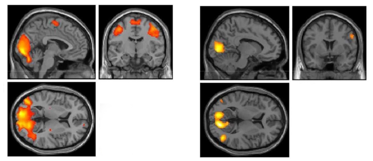 Brain scans of football players versus cross-country runners